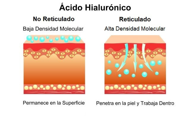 Diferencias entre Ácido Hialurónico reticulado y no reticulado | Dr. Díaz Infante - Madrid