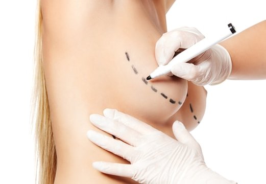 Elevación de mamas - Mastopexia con prótesis - Dr. Díaz Infante Madrid