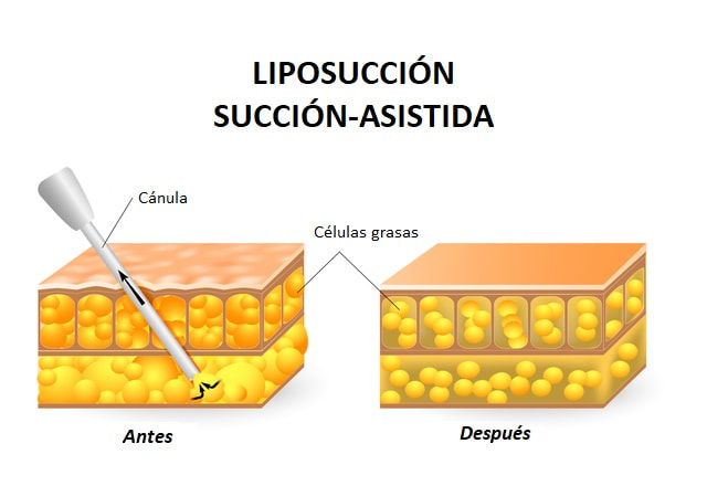 Liposucción proceso | Dr- Díaz Infante - Madrid