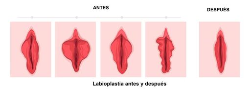 Labioplastia ¿Porqué cada vez más recurren a | Dr. Díaz - Madrid