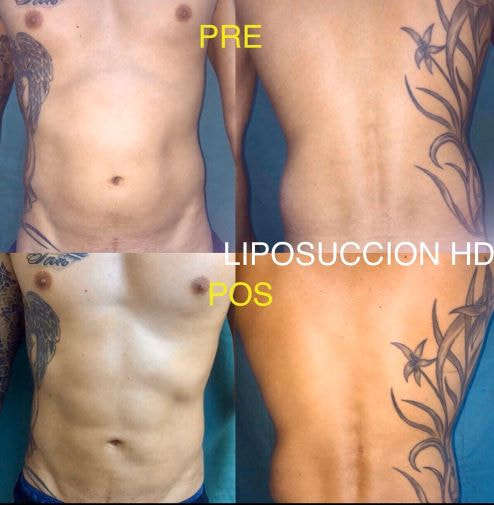 Liposucción HD - Alta Definición. Antes y Después | Dr. Díaz Infante - Madrid