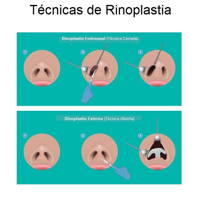 Rinoplastia Madrid - Dr. Díaz Infante