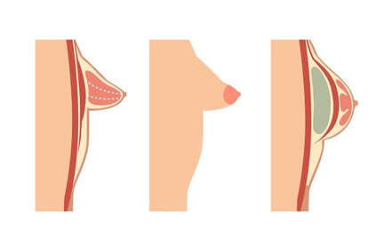 Aumento de pecho en mama tuberosa | Dr. Díaz Infante - Madrid