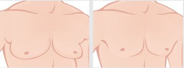 Reducción de mamas masculinas - Dr. Diaz Infante - Madrid