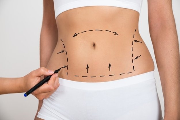 Qué tipo de ejercicios puedo hacer después de una abdominoplastia? -  Cirugia Martinez