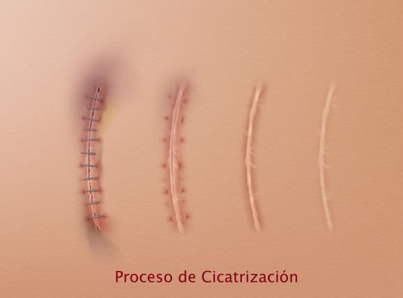 Cicatrices Postoperatorias - Cuidados | Dr. Díaz Infante - Madrid