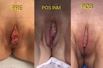 Labioplastia Antes y Después | Dr. Díaz Infante - Madrid
