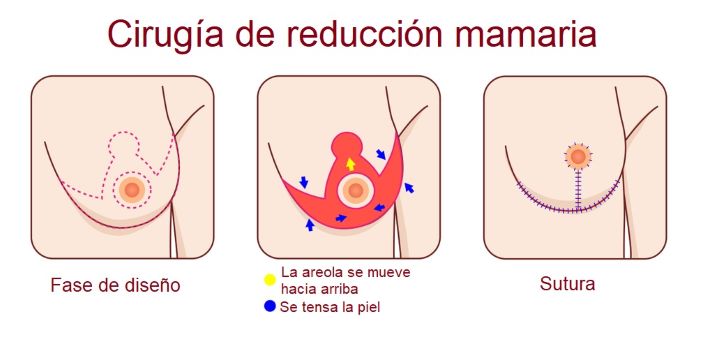 Reducción de mamas | Dr. Díaz Infante - Madrid