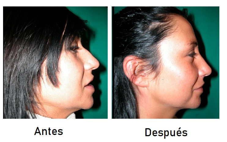 Rinomodelación.Antes y después. Dr.Díaz Infante. Madrid
